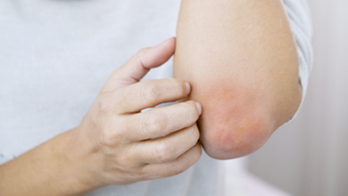 eczema causato da intolleranze alimentari - dermatite atopica