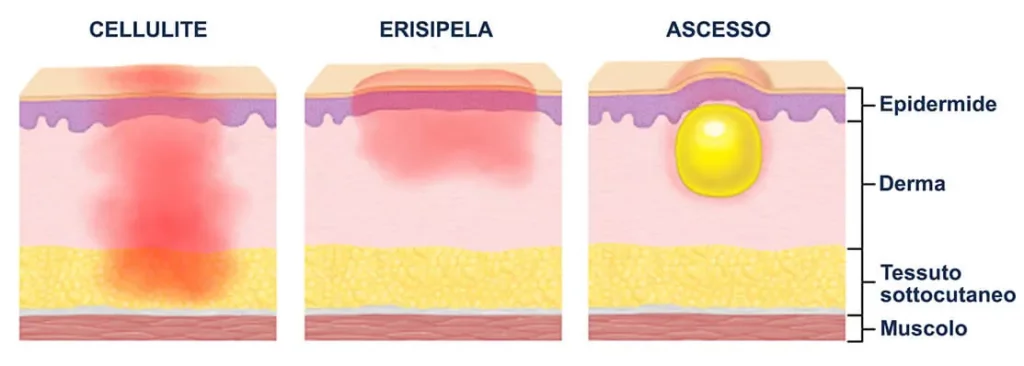 differenza tra erisipela e cellulite