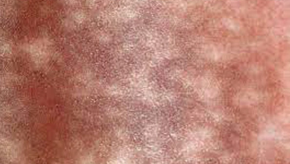 l'eritema ab igne è causato dall'esposizione ripetuta ai raggi infrarossi o al calore diretto sulla pelle