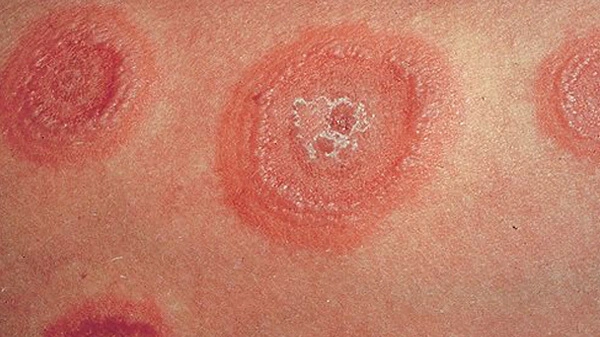 eritema marginatum: Il più delle volte si verifica in risposta alla febbre reumatica. Altre cause sono la malattia di Lyme, reazioni allergiche a farmaci o angioedema ereditario.
