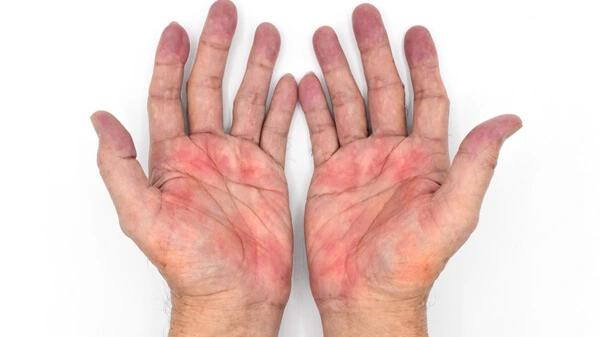 Eritema palmare: è un'eruzione cutanea rossa sui palmi delle mani e talvolta sulle dita.