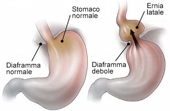 l'ernia iatale può causare bruciore di stomaco e difficoltà ad ingoiare