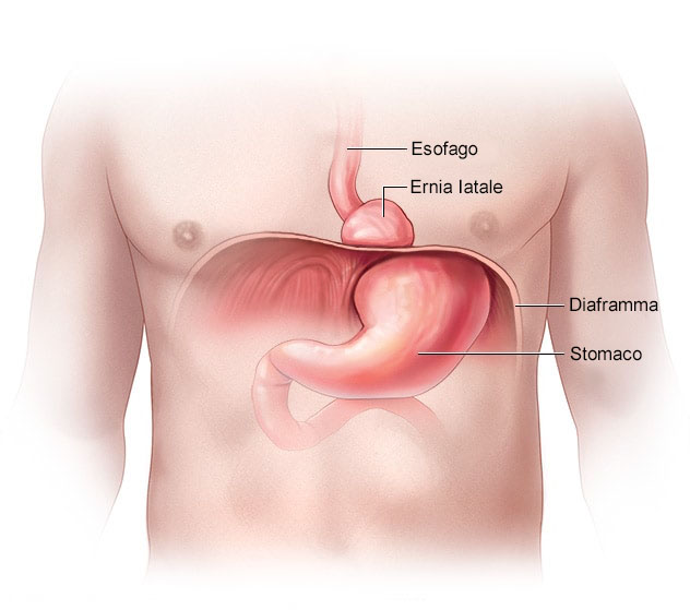 L'ernia iatale si verifica quando una parte dello stomaco fuoriesce nel torace attraverso il foro nel diaframma in cui passa l’esofago