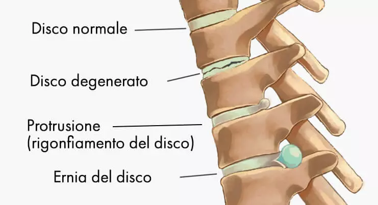 schema dei problemi dei dischi intervertebrali, inclusa l'ernia del disco