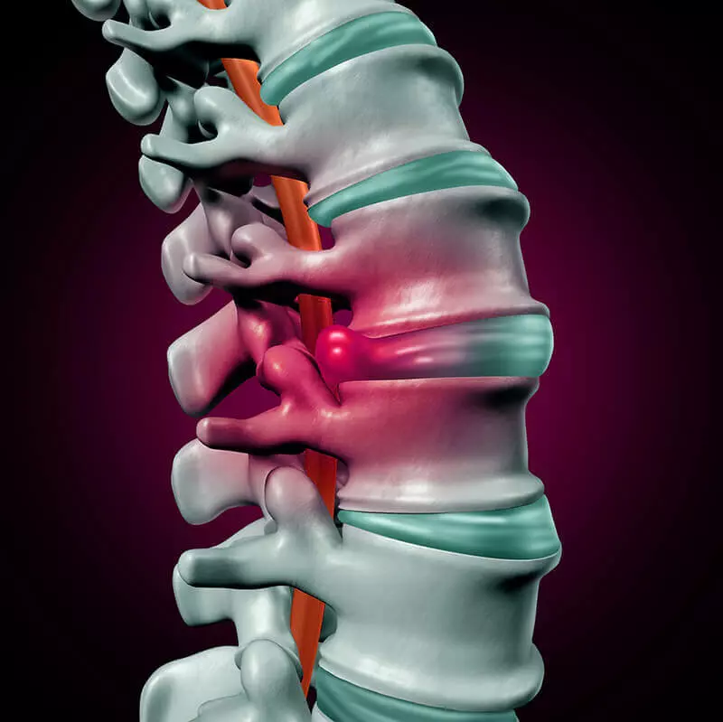 ernia del disco: sintomi, cause, trattamenti Biomediccenter
