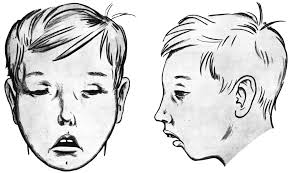 la facies adenoidea nota come "sindrome del viso lungo" ed è caratterizzata da una faccia lunga e magra con la bocca aperta.