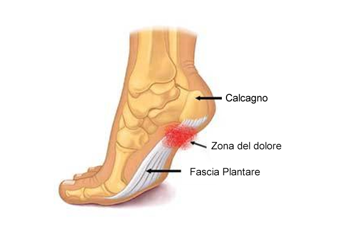 la fascite plantare è uno dei sintomi dell'artrite psoriasica