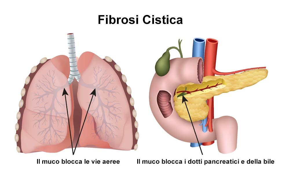fibrosi cistica polmoni e pancreas