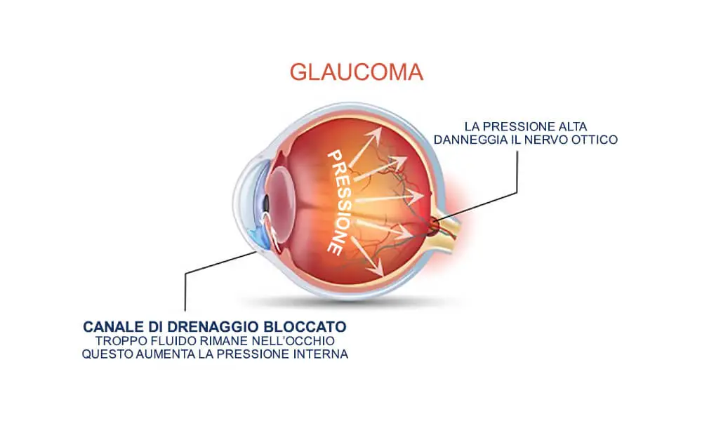 schema dell'aumento della pressione interna nell'occhio (glaucoma)