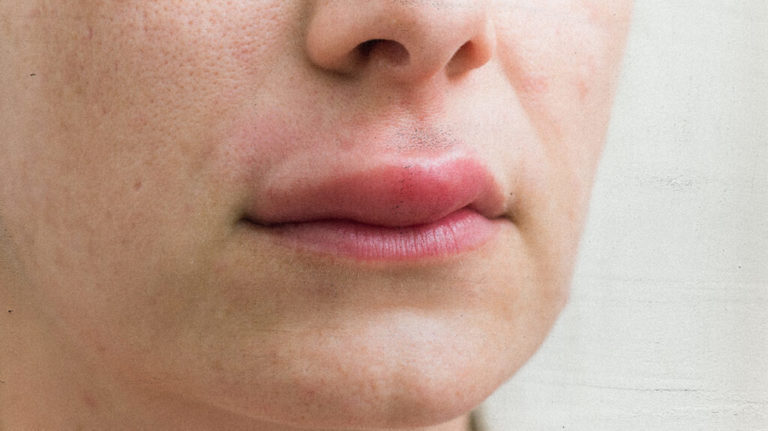 gonfiore alle labbra da allergia alimentare