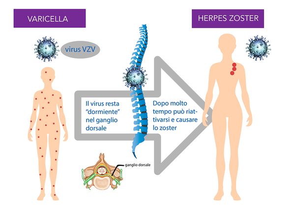 herpes zoster fuoco di sant'antonio