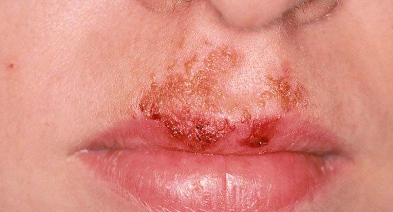 impetigine sul viso di un bambino: eruzione cutanea con croste gialle (impetigine non bollosa)