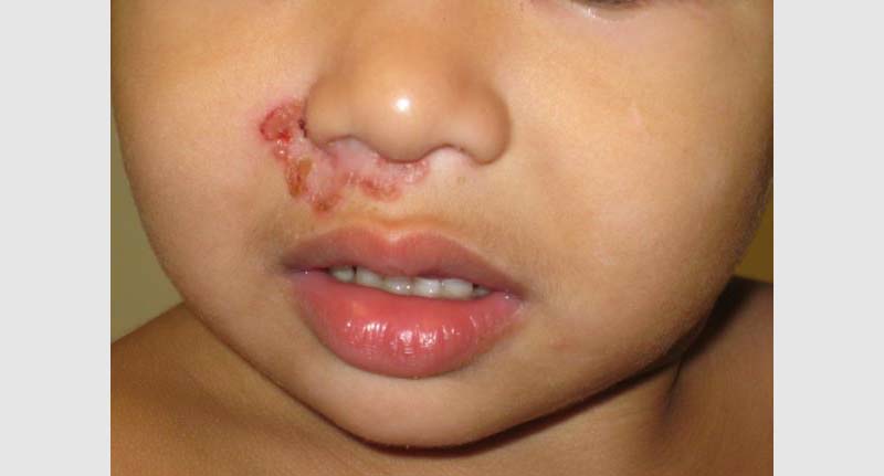 impetigine non bolsa in un bambino piccolo