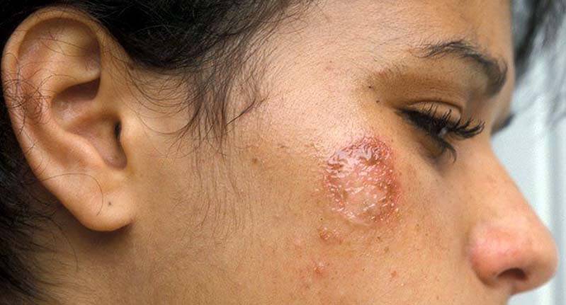 riconoscere l'impetigine e distinguerla da altre eruzioni cutanee