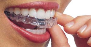 apparecchi ortodontici trasparenti invisalign