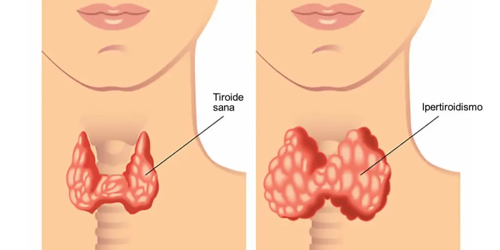 ipertiroidismo: schema di tiroide sana e tiroide affetta