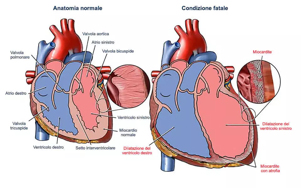 cuore sano e cuore con miocardite