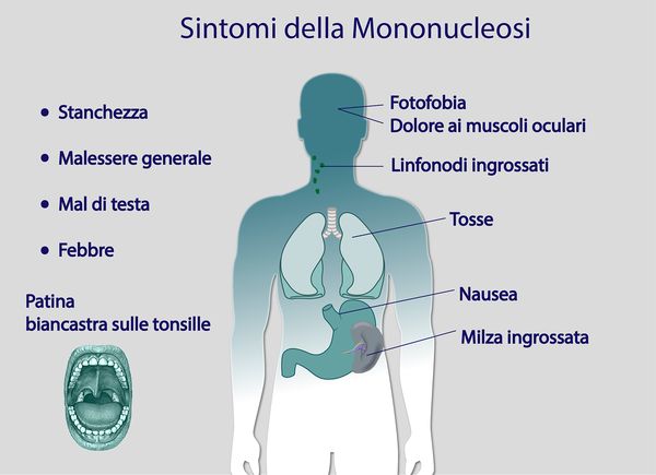 mononucleosi