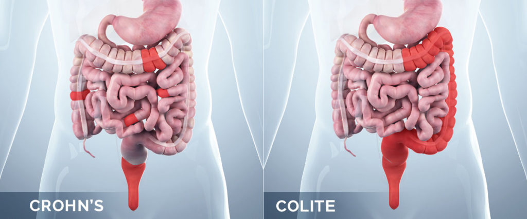 morbo di crohn e colite ulcerosa differenze