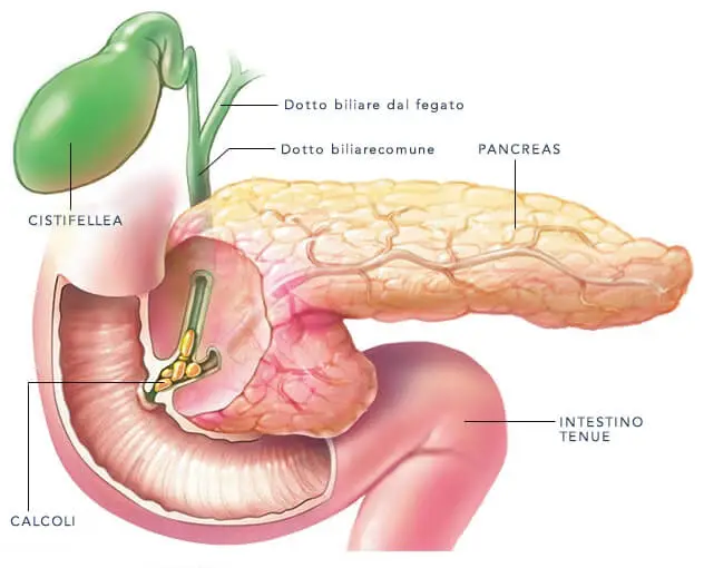 la causa della pancreatite sono spesso i calcoli biliari