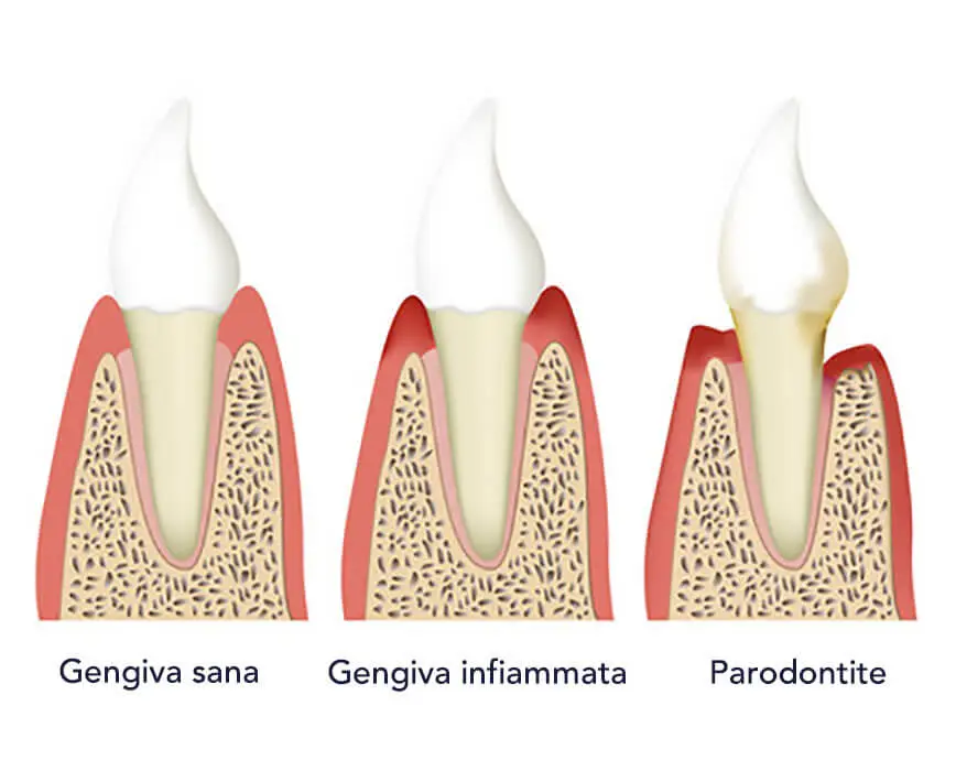 LE FASI DELLA PARODONTITE