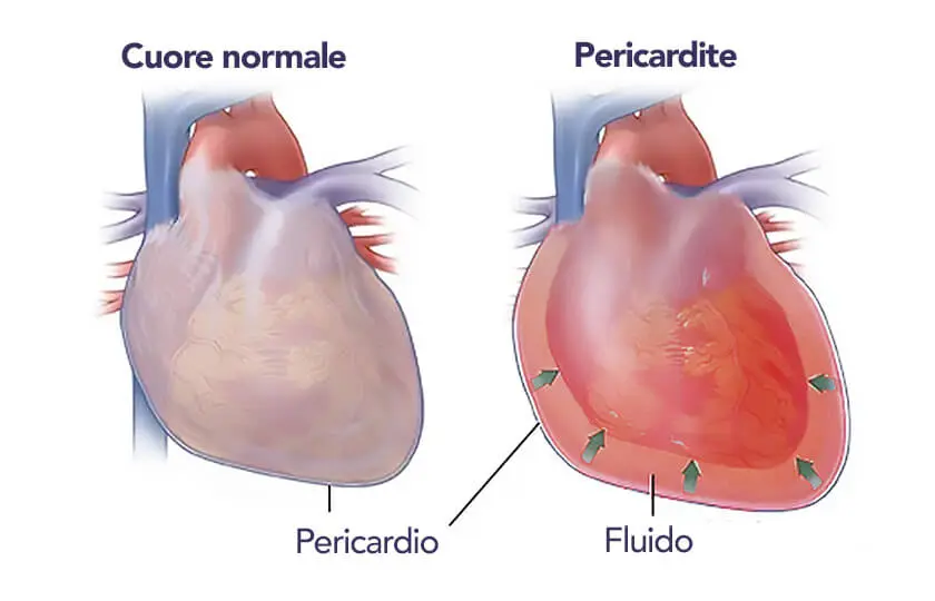 pericardite: sintomi, cause e trattamenti