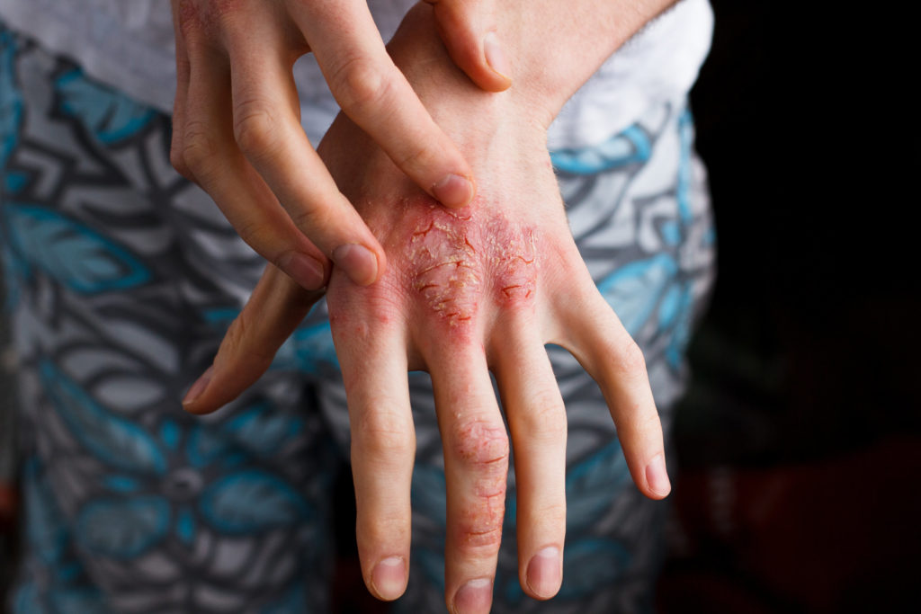 psoriasi o eczema sulle mani