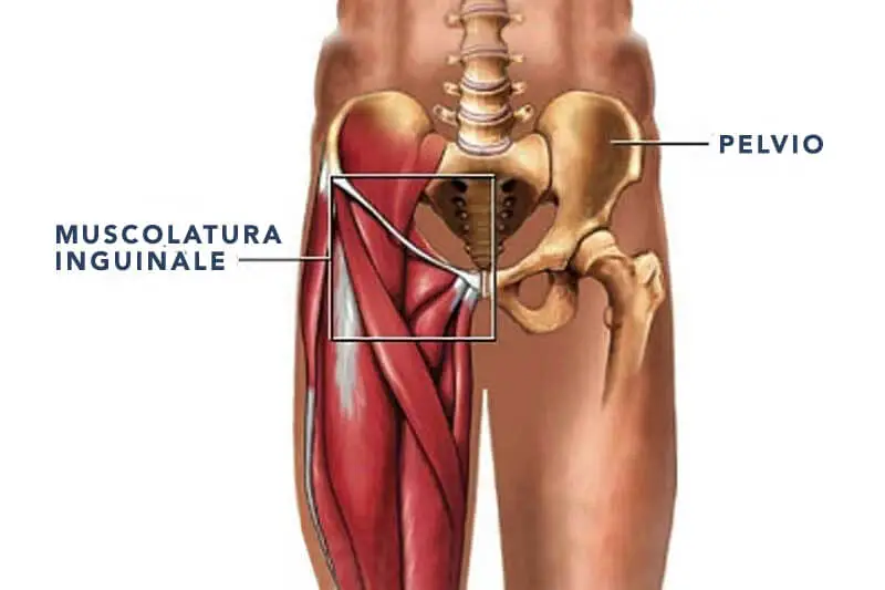 pubalgia