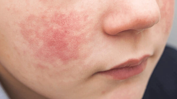 La quinta malattia è un eritema infettivo che si presenta come un'eruzione cutanea rossa sul viso