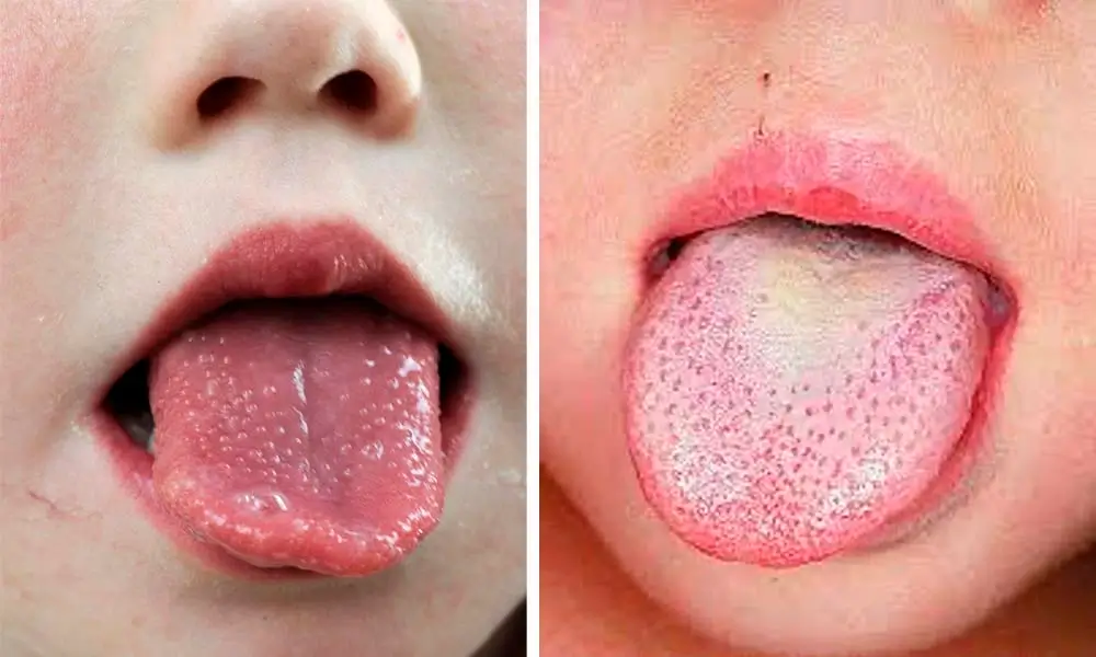 la scarlattina può causare una lingua di fragola o una lingua bianca con puntini rossi
