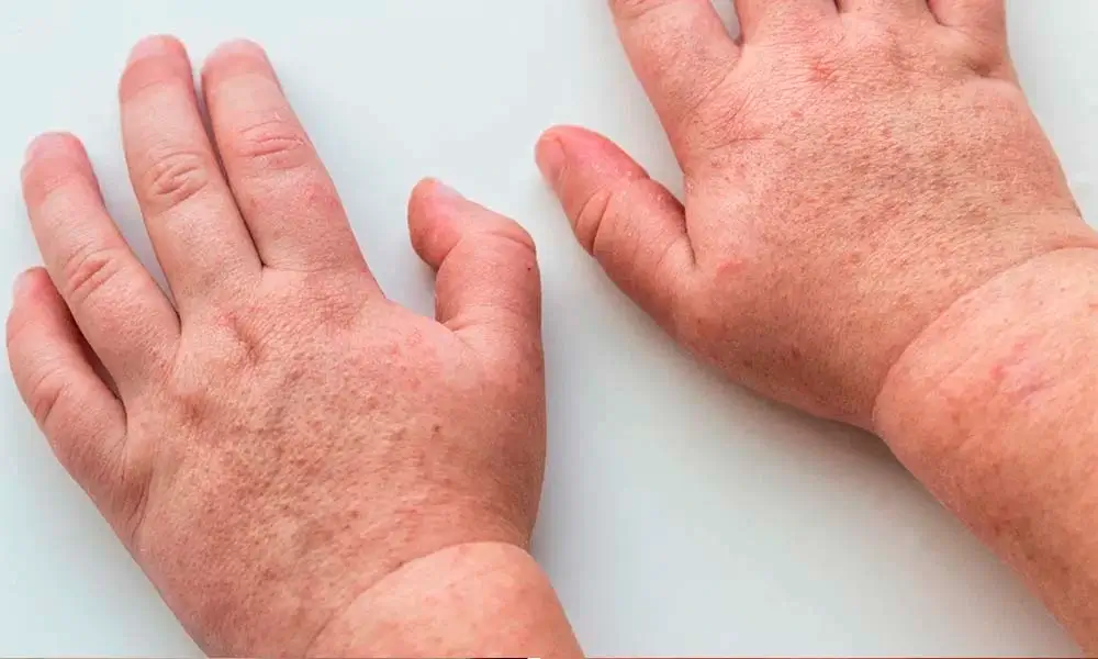 scarlattina: punti rossi sulle mani del bambino
