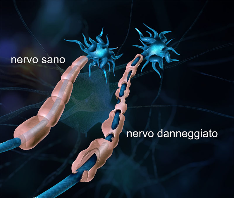 sclerosi multipla nervo sano e nervo danneggiato