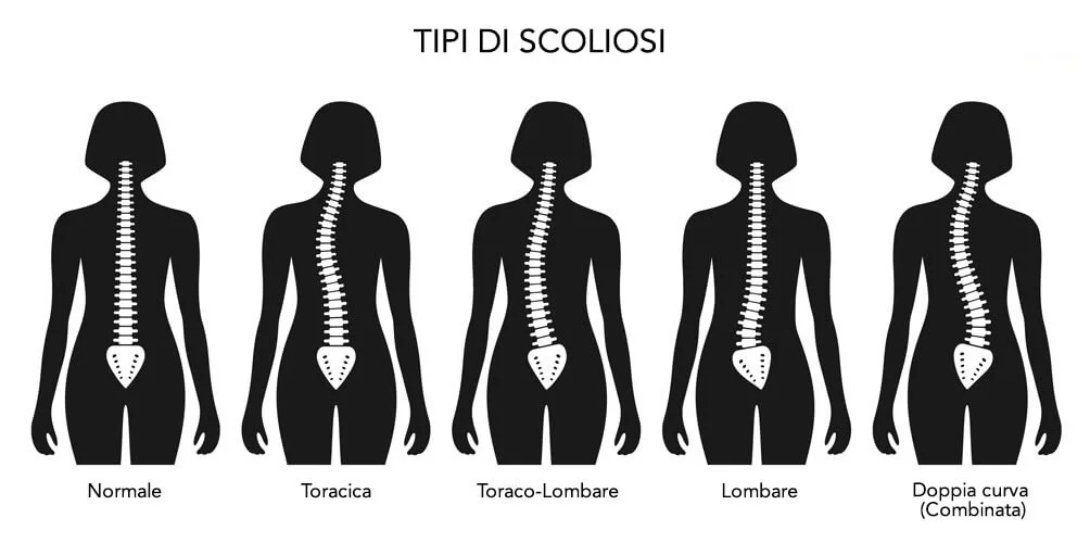 tipi di scoliosi