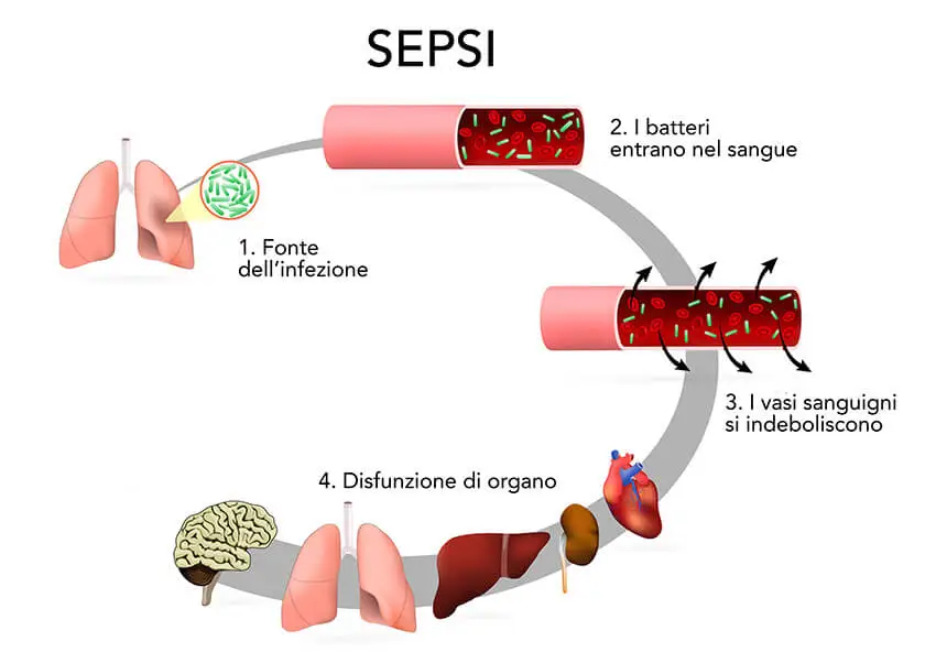 come si sviluppa la sepsi