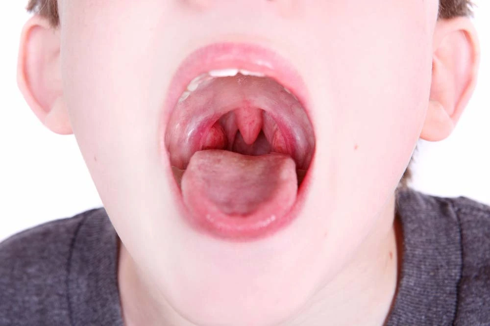 sintomi della tonsillite: ugola gonfia, tonsille gonfie e rosse