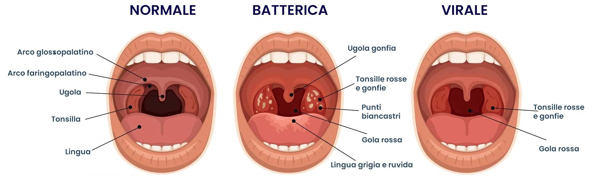 tonsillite batterica e virale