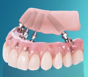il toronto bridge è una protesi fissa totale che viene inserita sugli impianti dentali che a loro volta sono integrati nell’osso attraverso delle viti.