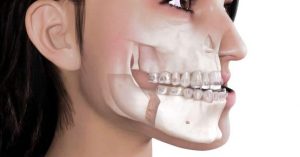 trattamento ortodontico prechirurgico