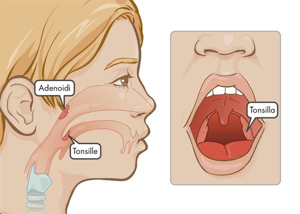 l'adenoidite è l'infiammazione delle adenoidi
