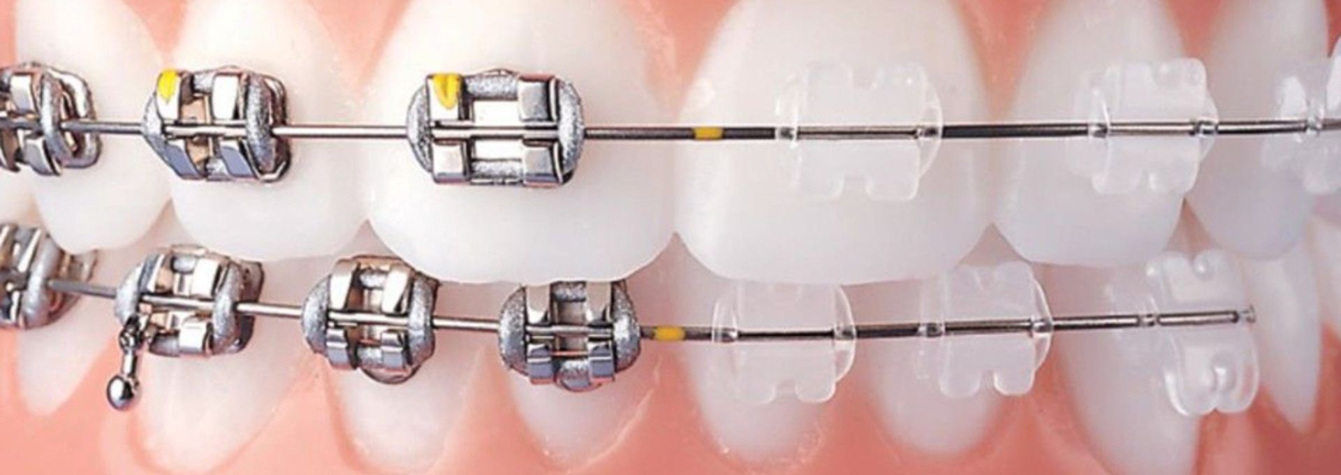 apparecchio denti fisso