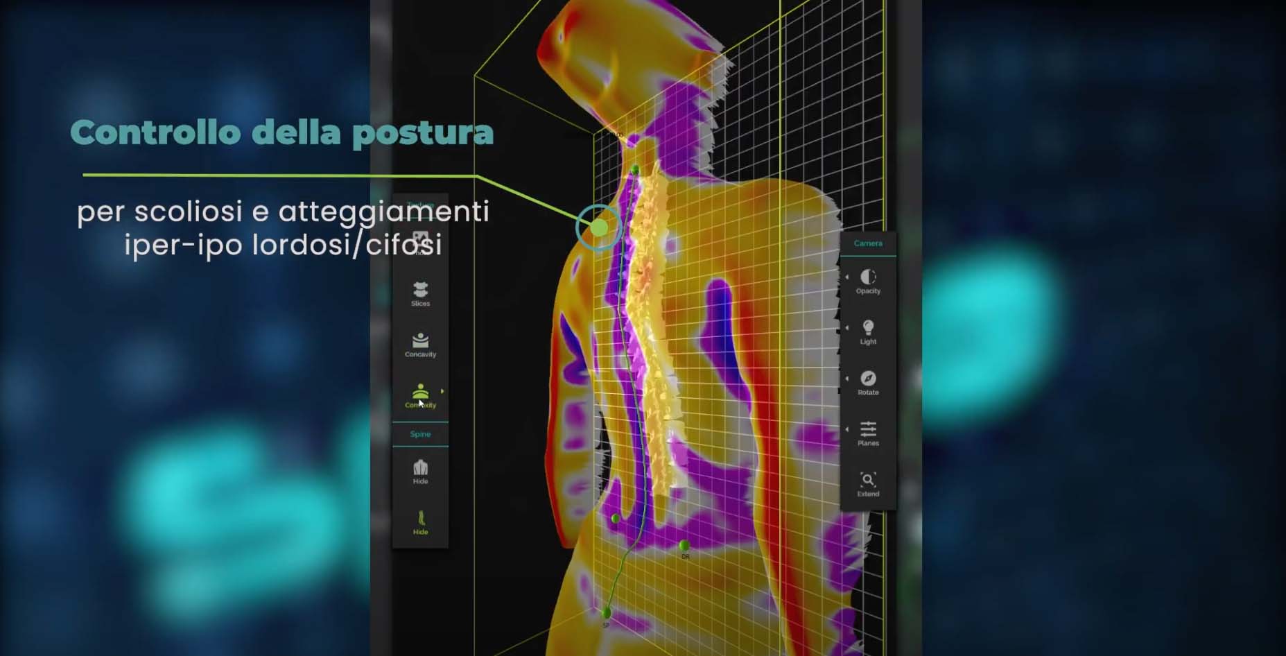 controllo della postura per scoliosi, lordosi, cifosi