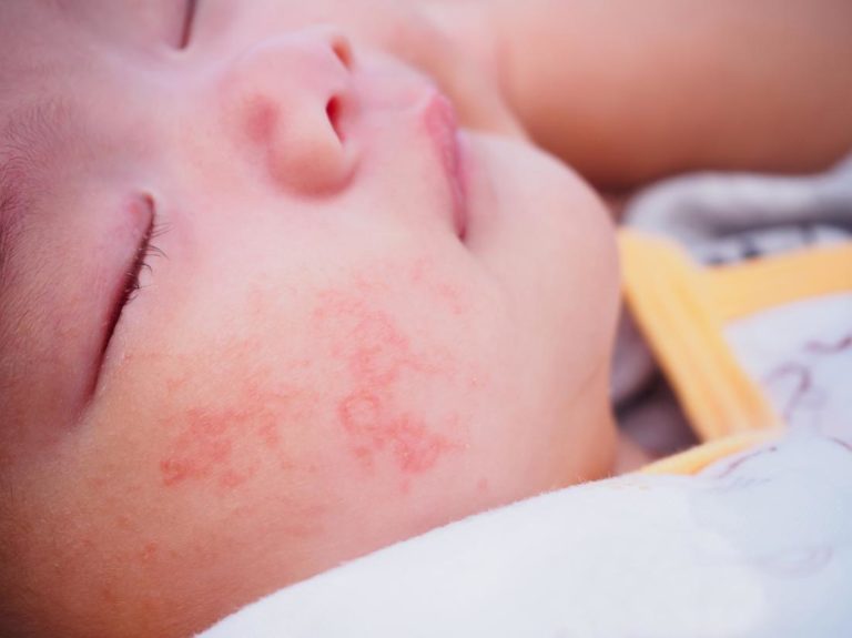 bambino con eczema allergia al latte