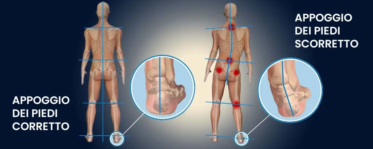IMPATTO DI UN APPOGGIO DEI PIEDI SCORRETTO