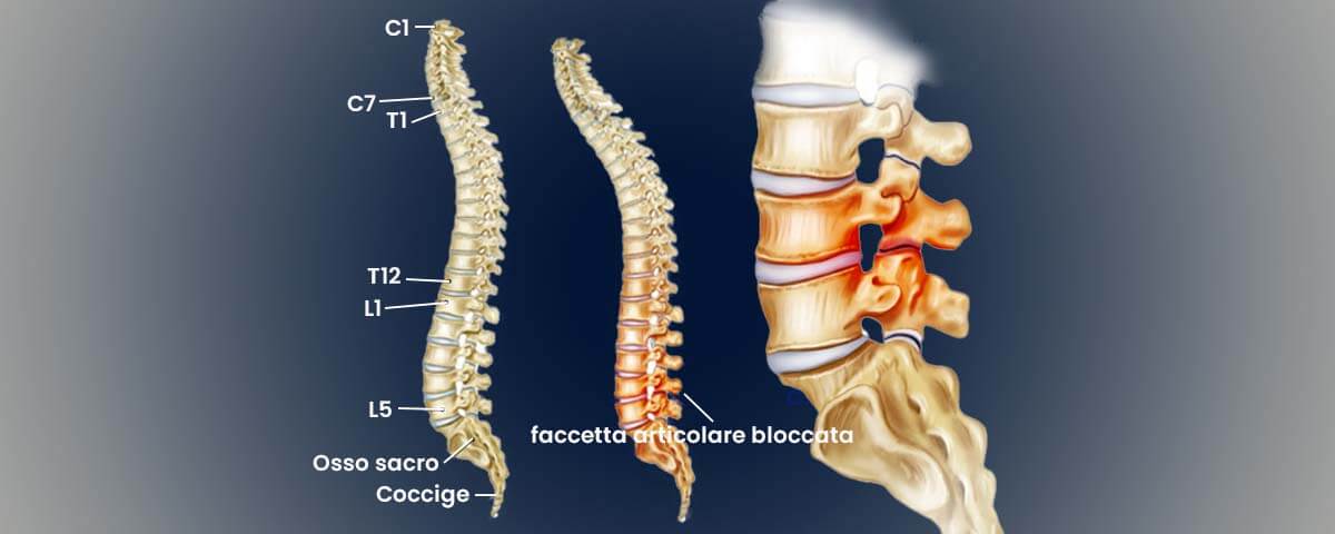 Lombalgia: anatomia del plesso lombare