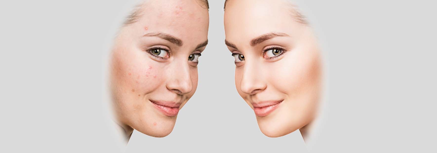 eliminare i segni dell'acne con il laser
