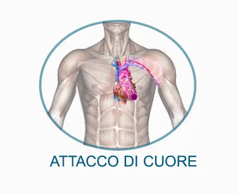 Attacco di cuore