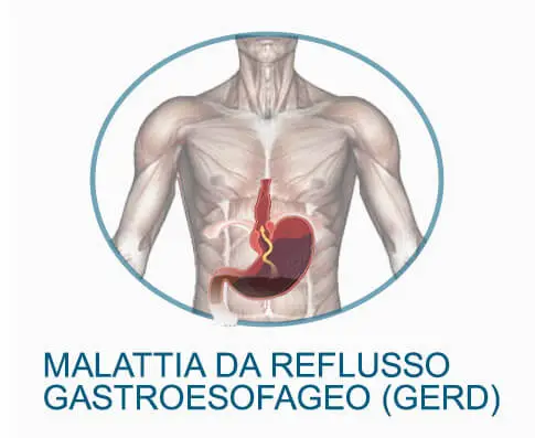 LA MALATTIA DEL REFLUSSO GASTROESOFAGEO PUO' ESSERE LA CAUSA DEL DOLORE AL PETTO