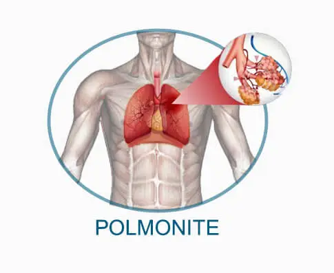 LA POLMONITE CAUSA DOLORE AL PETTO