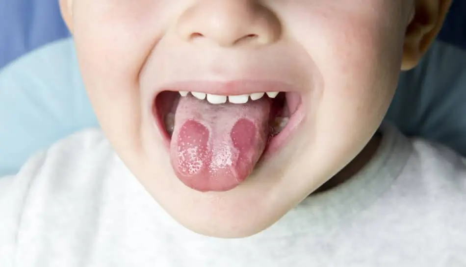 lingua bianca da stomatite erpetica