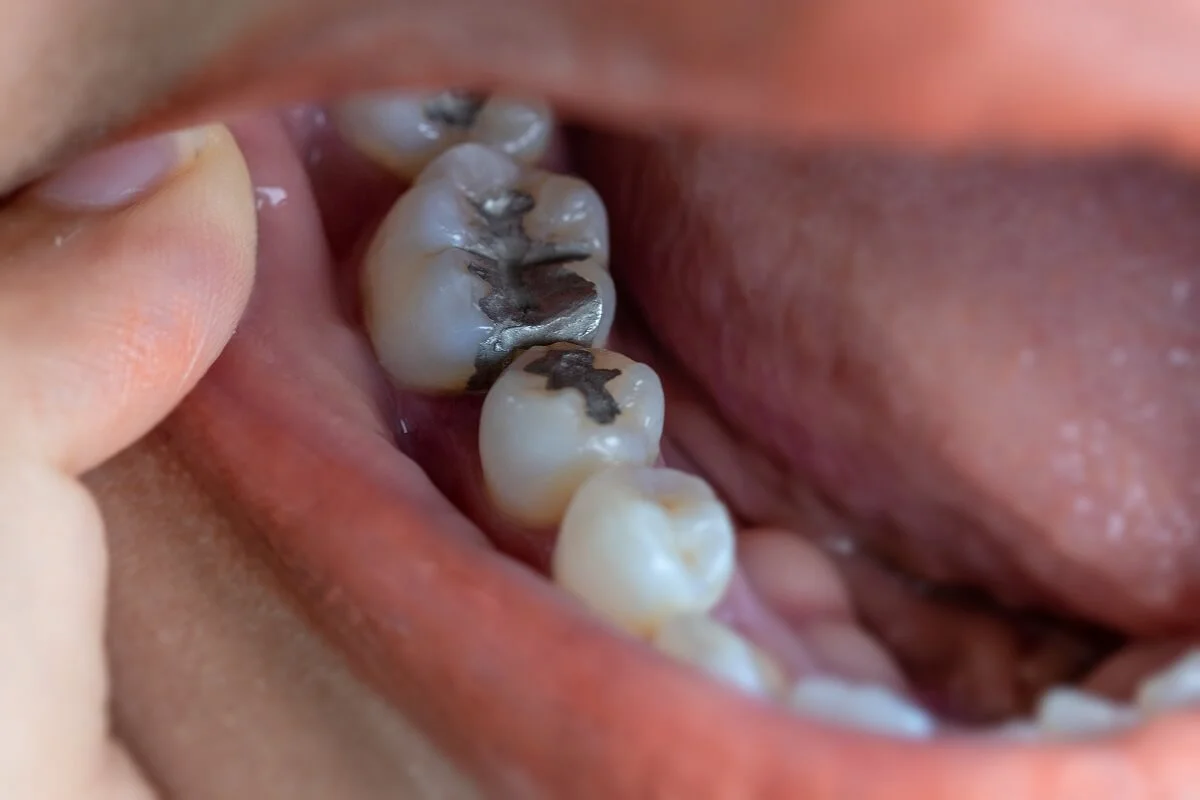 amalgame dentali perché è importante per la salute rimuoverle